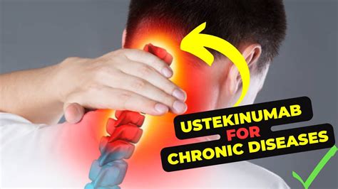 Ustekinumab Uncovered Exploring Uses Side Effects And More Youtube