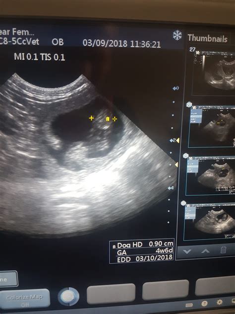 7 Week Ultrasound 2022