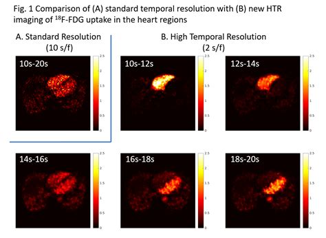 High Temporal Resolution Htr Parametric Pet New Kinetic Modeling