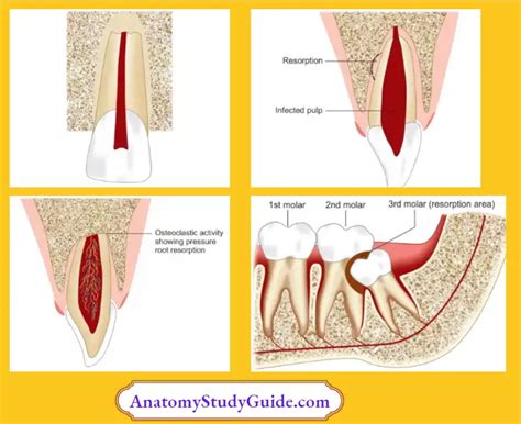 Dental Root Resorption Classification Diagnosis Notes Anatomy Study Guide