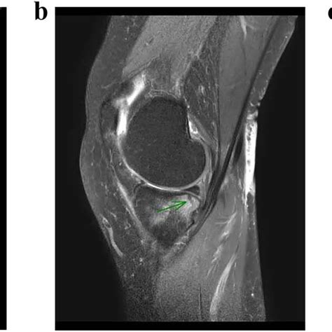 T2-weighted sagittal MRI showed full-thickness tear of the distal... | Download Scientific Diagram