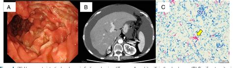 Figure 1 from Disseminated Mycobacterium avium Complex Infection in a ...