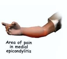 Golfers Elbow Surgical Treatment For The Recalcitrant Cases Hc