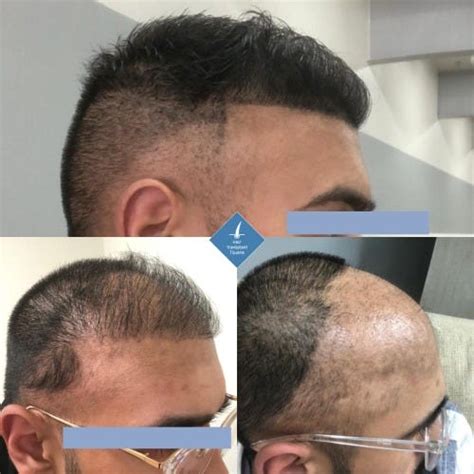 Hair Transplant Mexico Hair Transplant Tijuana