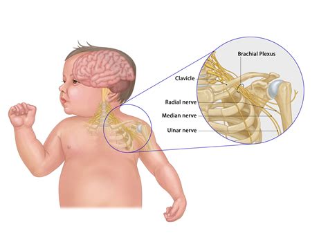 Brachial Plexus Palsy Or Erb S Palsy Chapter 25 Midwifery For