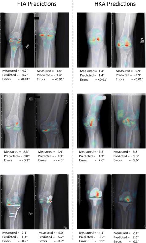 Predicting Hip Knee Ankle And Femorotibial Angles From Knee Radiographs