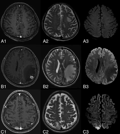 Diffusion-Weighted Imaging of Brain Metastasis from Lung Cancer: Correlation of MRI Parameters ...