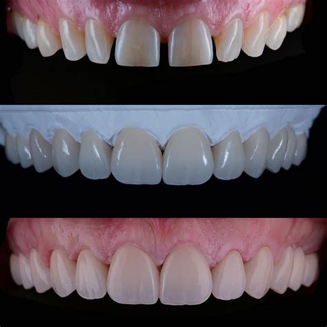 Before and After Gallery | Value Dental Centres