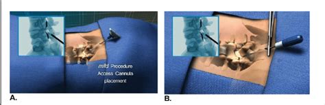 Illustrations Describe The Mild Trocar A And Portal B Positioning Download Scientific