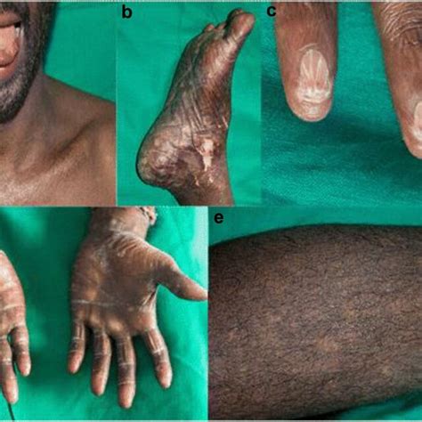 Epidermodysplasia Verruciformis Versicolor Macules On The Neck A And