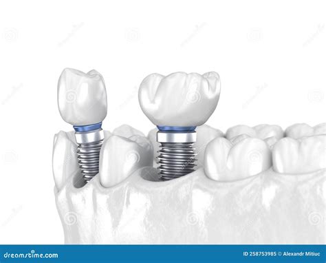 Premolar And Molar Tooth Crown Installation Over Implant White