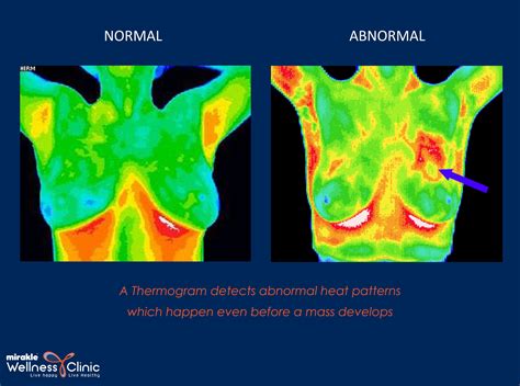 Breast Thermography In India Breast Thermography Cost Mirakle Wellness Clinic