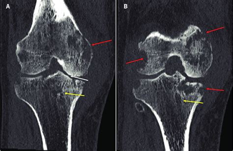 Serial Computed Tomography Scans Coronal View Of The Right Knee Of A