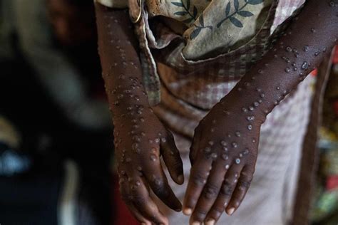 Philippines Mask Mandate Lockdowns Not Needed To Control Mpox