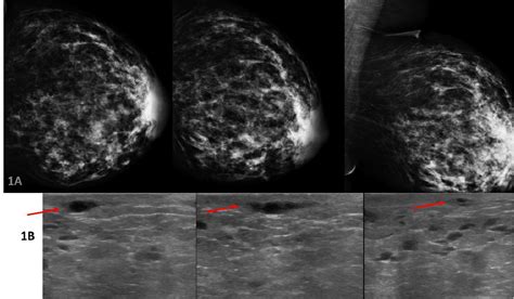 Figure 1 From Sono Mammographic Findings Of Mondor`s Disease Of The Breast Semantic Scholar