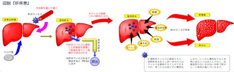 図解「肝疾患の解説」｜大阪公立大学医学部附属病院 大阪府肝疾患診療連携拠点病院