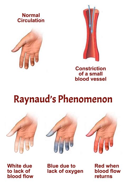 Raynauds Phenomenon Aps Foundation Of America Inc