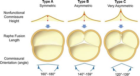 Repair Oriented Bicuspid Aortic Valve Classification According To Download Scientific Diagram