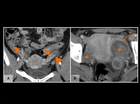 Hydrosalpinx Coronal A Enhanced Scan Ct Show Thickened And Enhanced