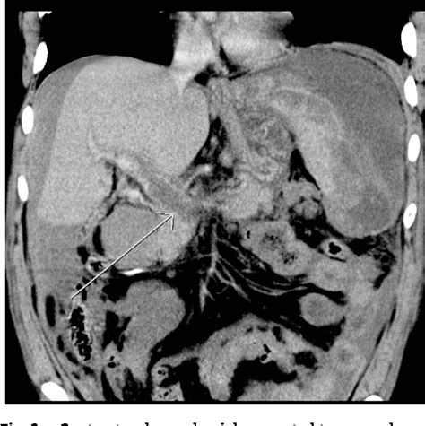 Figure 1 From Atraumatic Splenic Rupture Precipitated By Splenic Vein