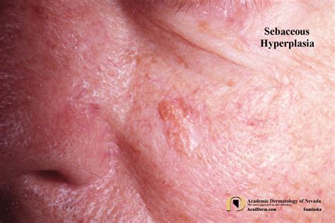 Sebhyperplasia1samlaska Academic Dermatology Of Nevada