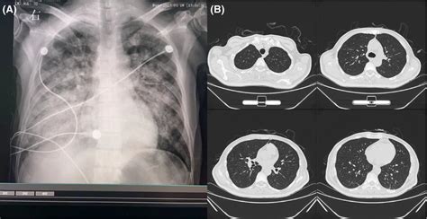 Lung images. (A) Chest X‐ray is taken approximately 1 h after ...