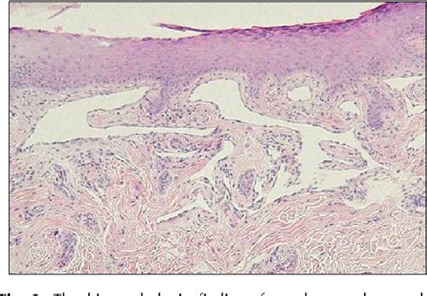 Figure 3 From A Case Of Hereditary Hemorrhagic Telangiectasia