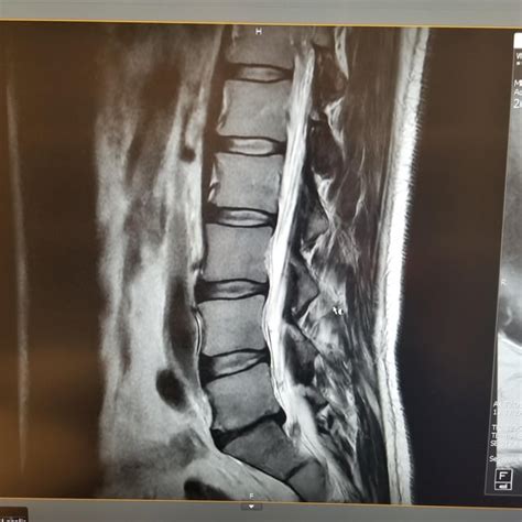 My L5-S1 ISsues : r/backpain