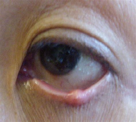 Sebaceous Cell Carcinoma Eyelid