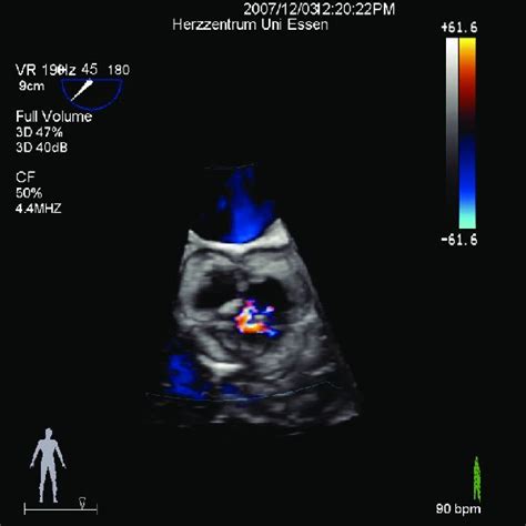 Transesophageal Echocardiogram 3 Dimensional View With Color Flow