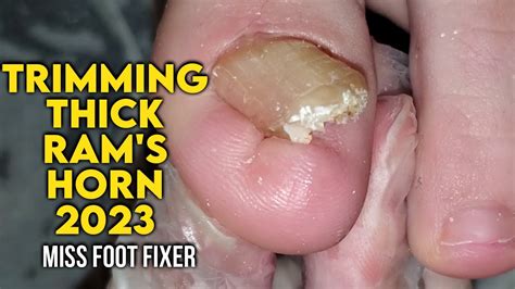 Trimming Thick Ram S Horn Toenail Thick Curved Nail Treatment