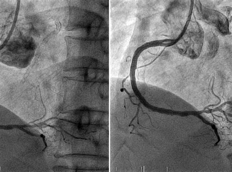 Invasive Coronary Angiography - Cos Cardio