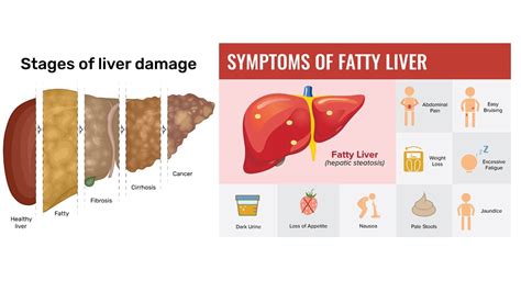 Fatty liver disease