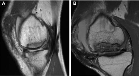 Eight Month Postoperative Sagittal Magnetic Resonance Images Showing