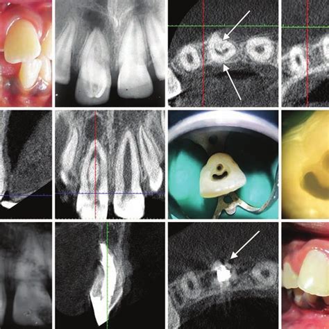 PDF Endodontic Management Of Dilacerated Maxillary Central Incisor