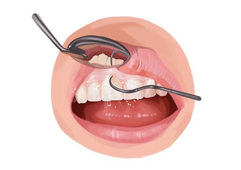 Scaling And Root Planing Procedure Effectiveness And Risks