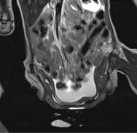 Three Dimensional Imaging In A Month Old Girl With A Covered Cloacal