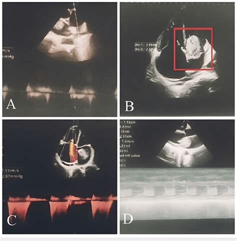 Preoperative echocardiography (A) dilated left atrium; (B) large left... | Download Scientific ...