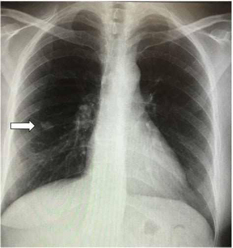 Chest Radiograph Demonstrating A 16 Mm Pulmonary Nodule In The Right