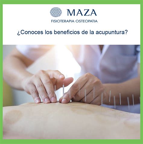 CONOCES LOS BENEFICIOS DE LA ACUPUNTURA