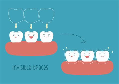 Why You Should Choose Invisalign Carlingwood Dental Centre