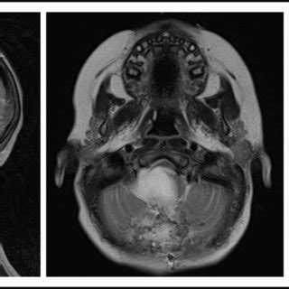 MRI imaging of non-DIPG case 13. The tumor origin is nearly completely... | Download Scientific ...