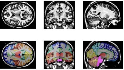 Brain Mri Segmentation Ai Models