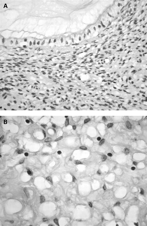 Signet Ring Cells Of Stromal Derivation In The Uterine Cervix Secondary