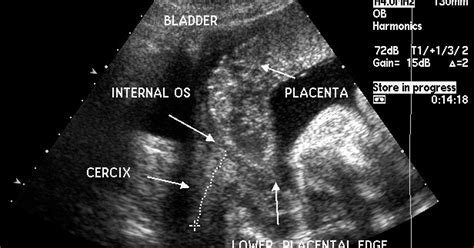 MEDICAL ULTRASOUND/PLACENTA PREVIA