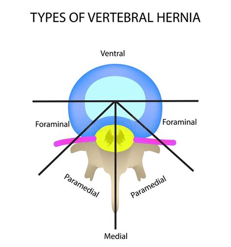 Types Of Hernia Epigastric Lateral Umbilical Inguinal Femoral