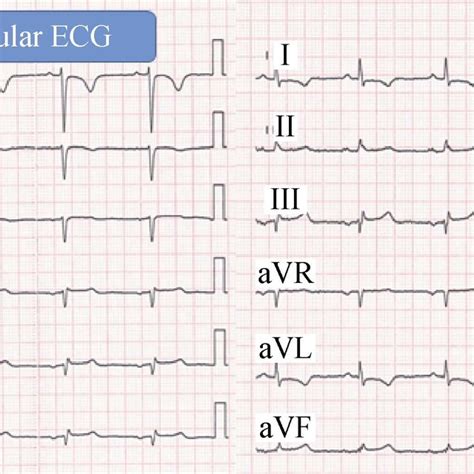 Regular And Modified Ecg Manifestation Of This Dextrocardia Patient On