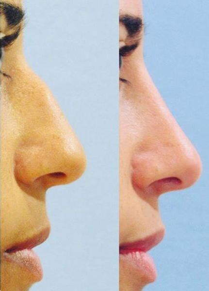 Nose Bump Treatment » Rhinoplasty: Cost, Pics, Reviews, Q&A