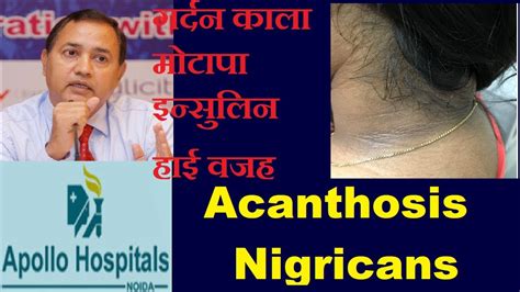 Acanthosis Nigricans Causes Treatment Delhi Significance High Insulin Dr B K Roy Youtube