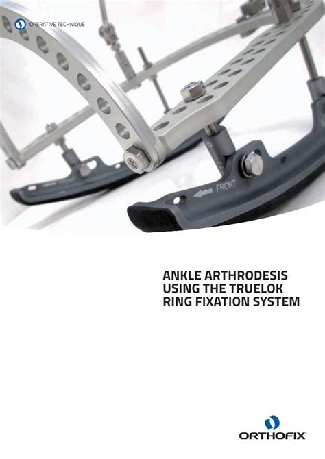 Pdf Ankle Arthrodesis Using The Truelok Ring Abs Orthofix It Db